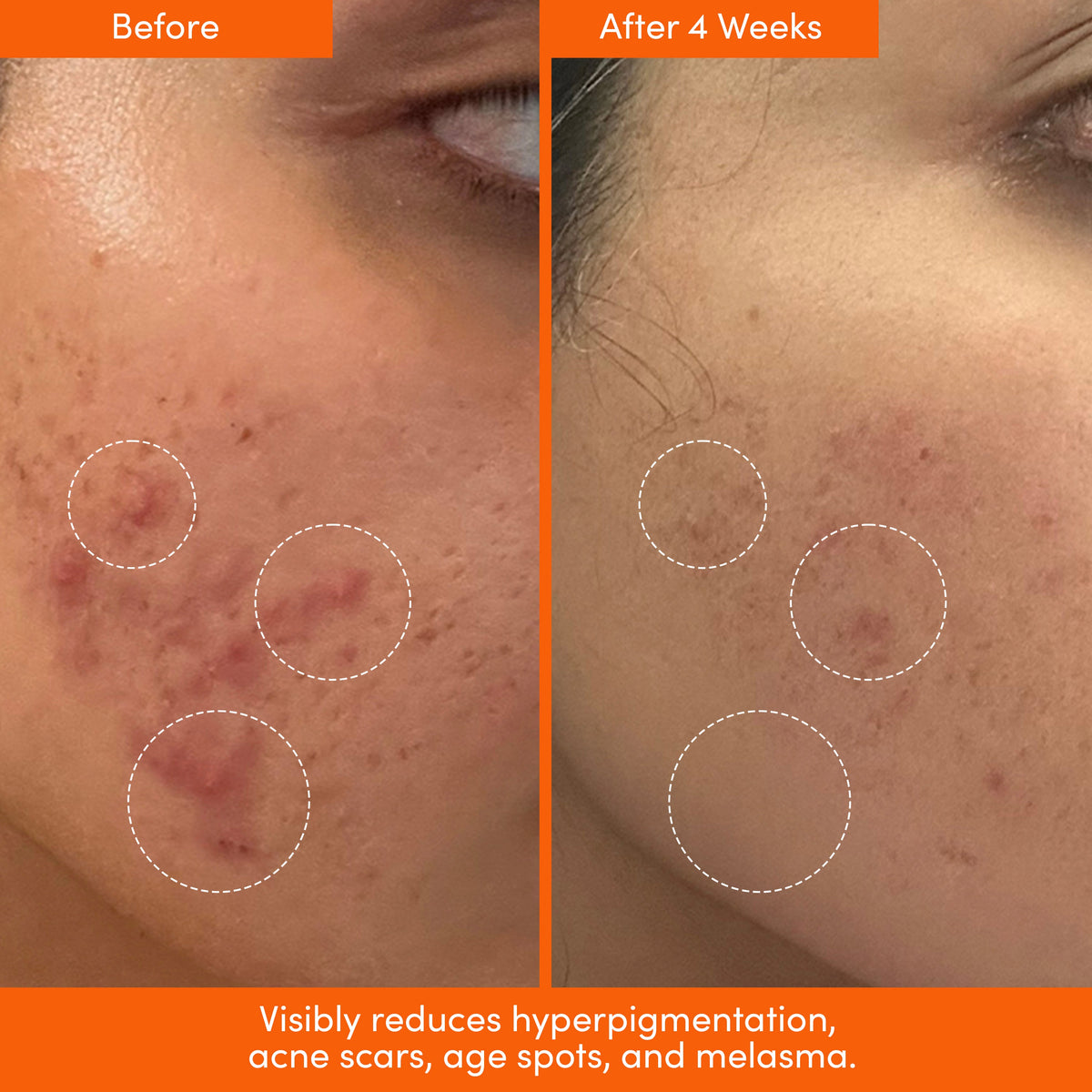 Before and after close-ups of acne-prone skin with circled areas
