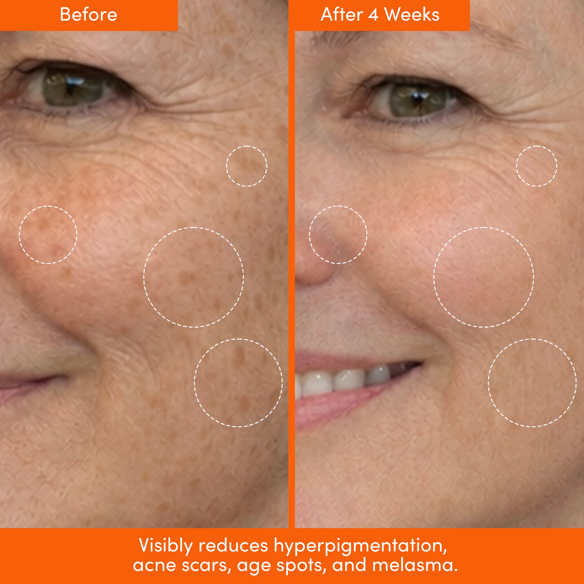 Before and after close-ups of an older woman's face with circled areas, labeled after 4 weeks