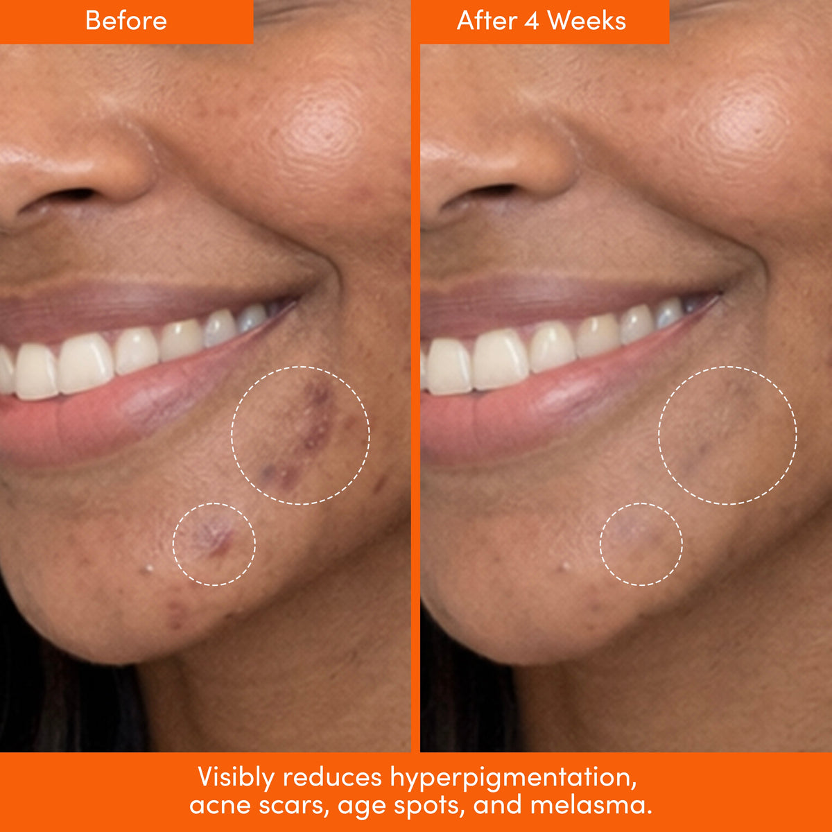 Before and after close-ups of a woman's cheek with circled areas, labeled after 4 weeks