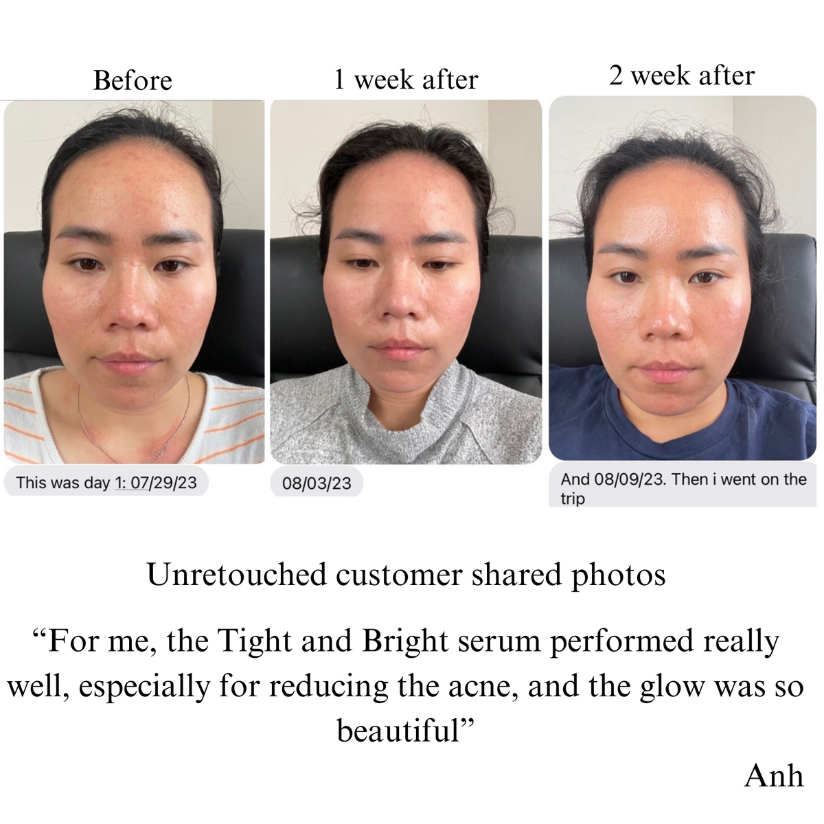 Three face photos of a customer: before, after 1 week and after 2 weeks, with a customer quote