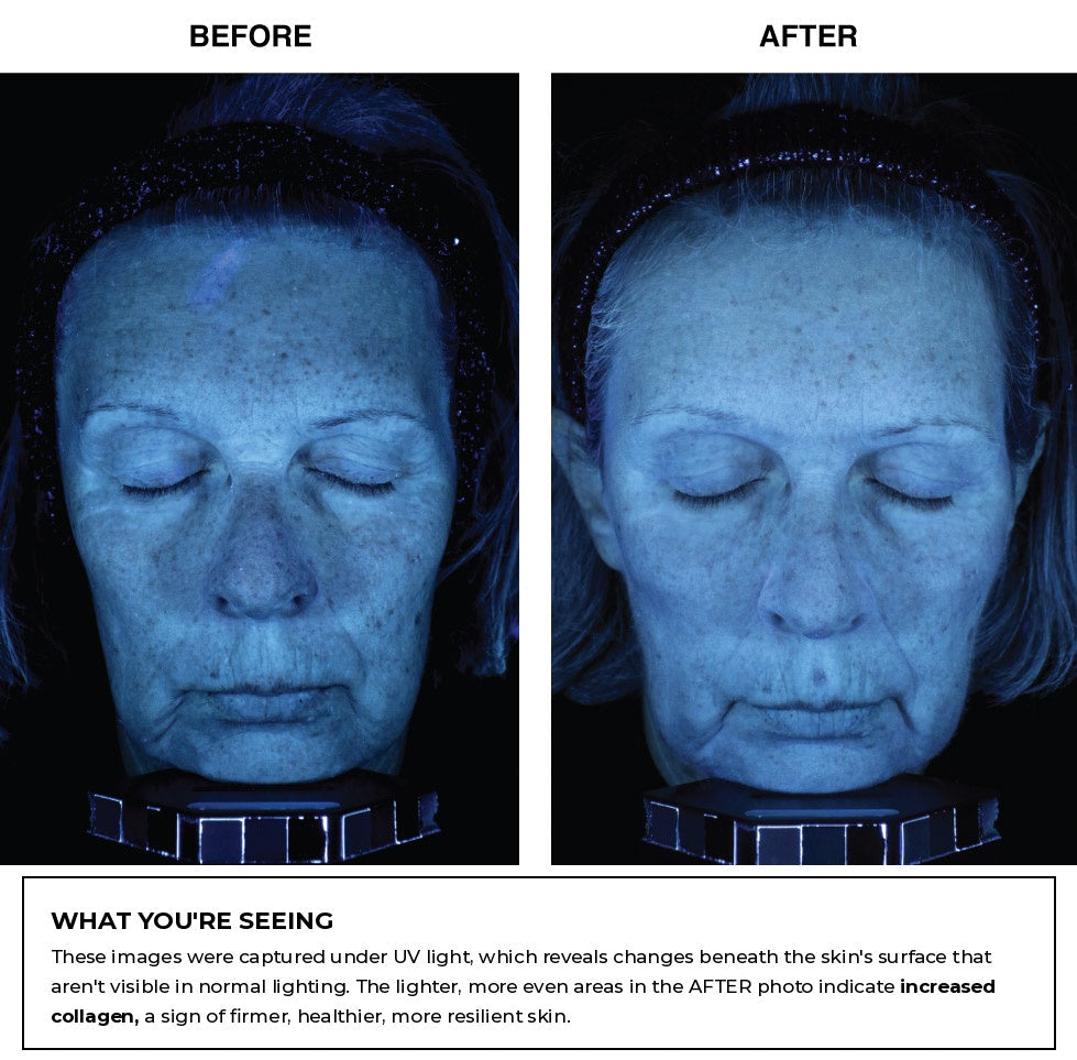 Before and after skin imaging photos under UV light, with a caption explaining what the images show