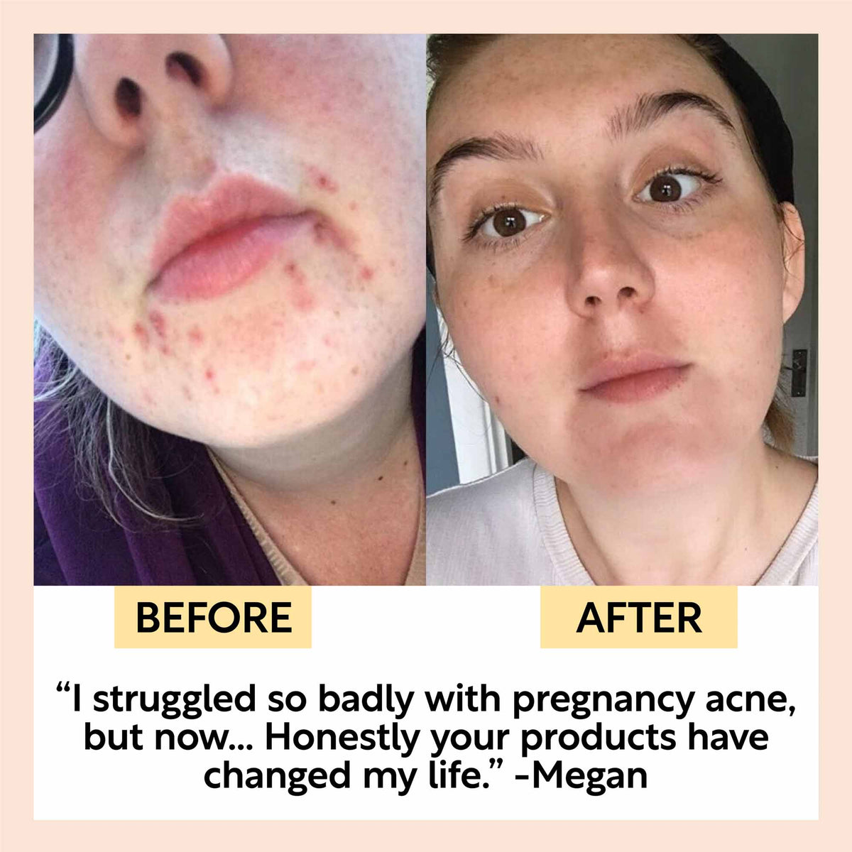 Before and after photos of a customer's skin with a quoted testimonial about acne