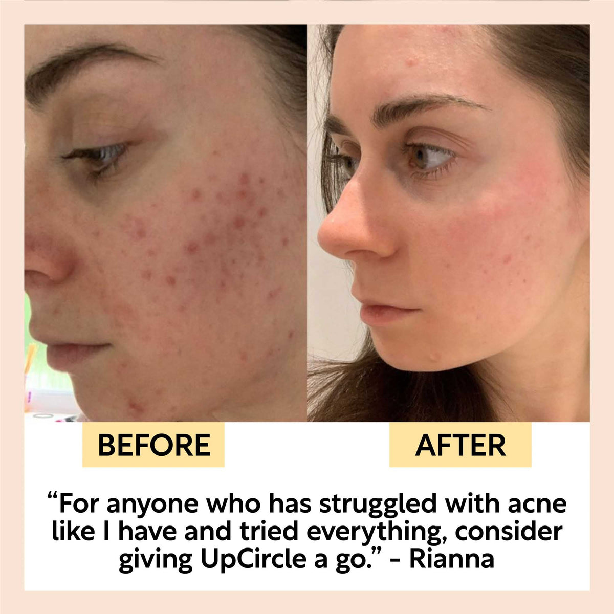 Before and after side profile photos of a customer's skin with a quoted testimonial