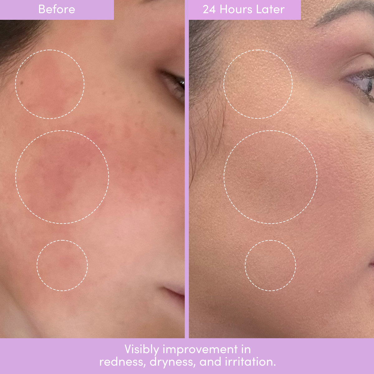 Before and after close-ups of a cheek with redness and circled areas