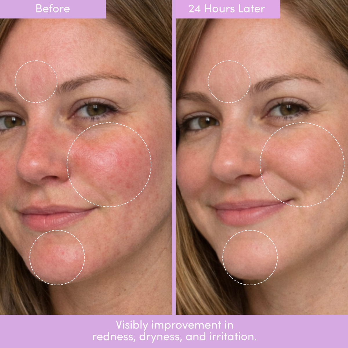 Before and after photos of a smiling woman with circled areas on her cheeks