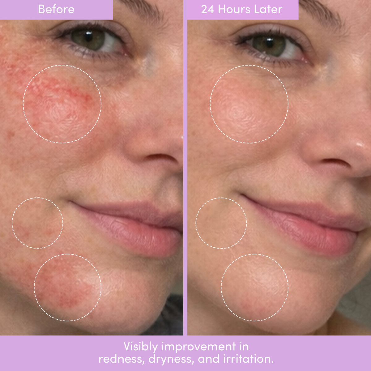 Before and after close-ups of a woman's cheek with redness and circled areas