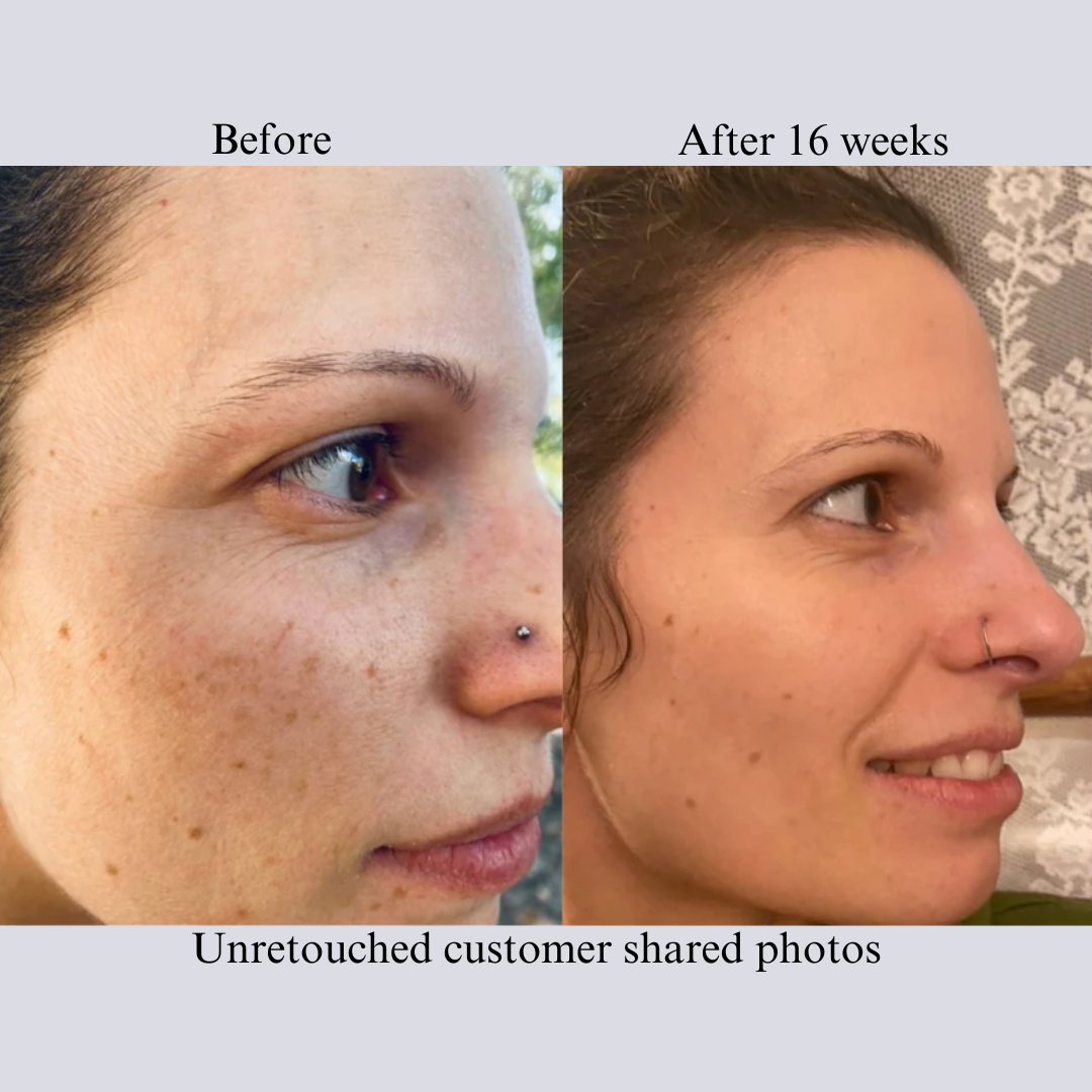 Before and after photos of a customer's cheek and side profile, labeled after 16 weeks