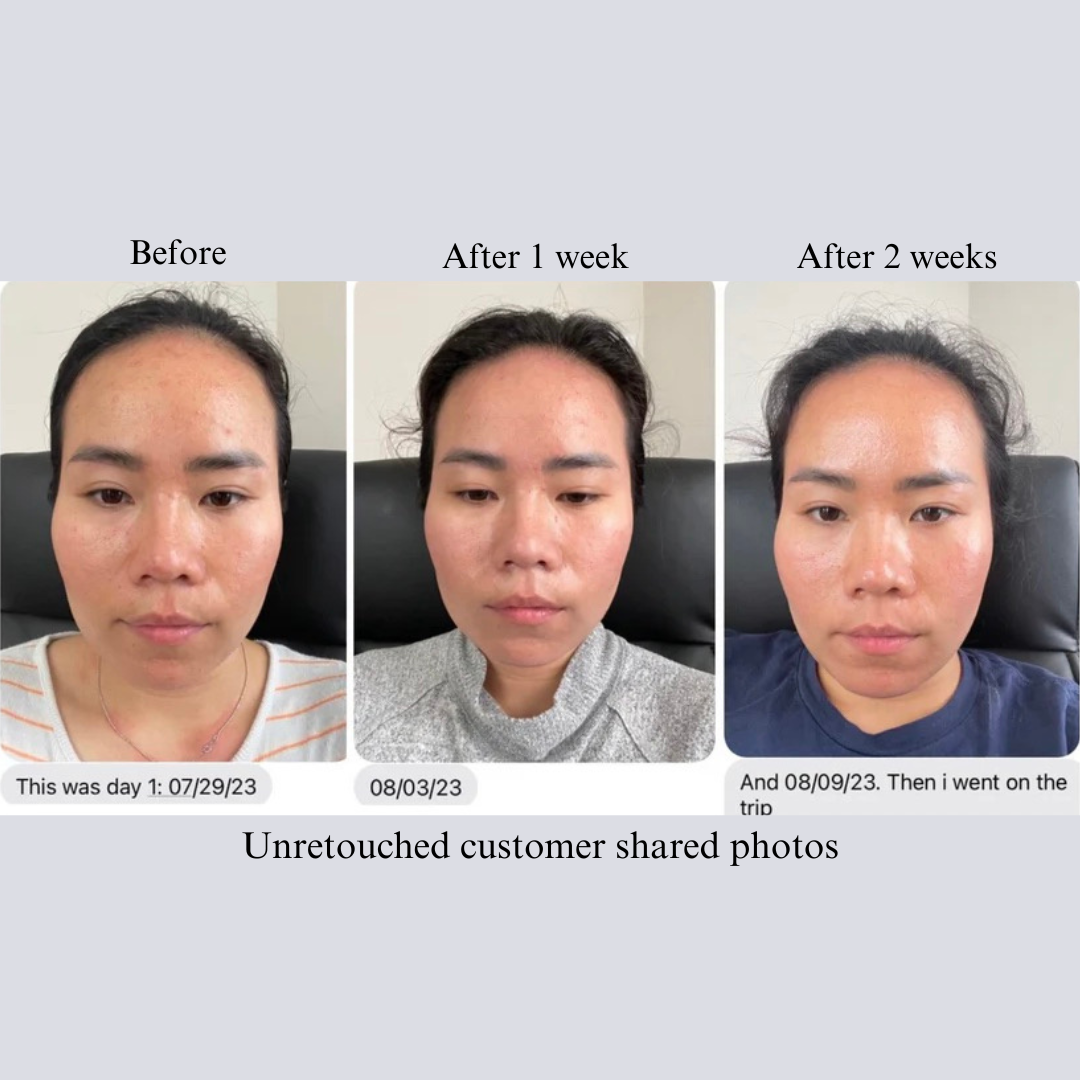 Three face photos of a customer: before, after 1 week and after 2 weeks