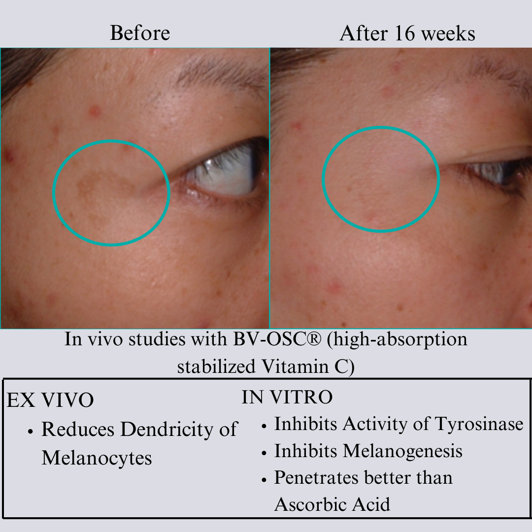 Before and after close-ups of an eye area with circled spots, labeled after 16 weeks, beside study text